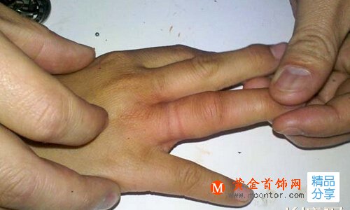 
戒指長期不摘有哪些危害？