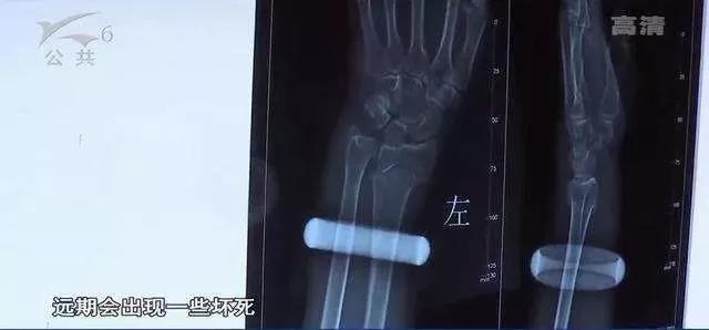 手鐲取不下來可以敲碎嗎？這些首飾不卡手，手鐲取不下來有妙招圖